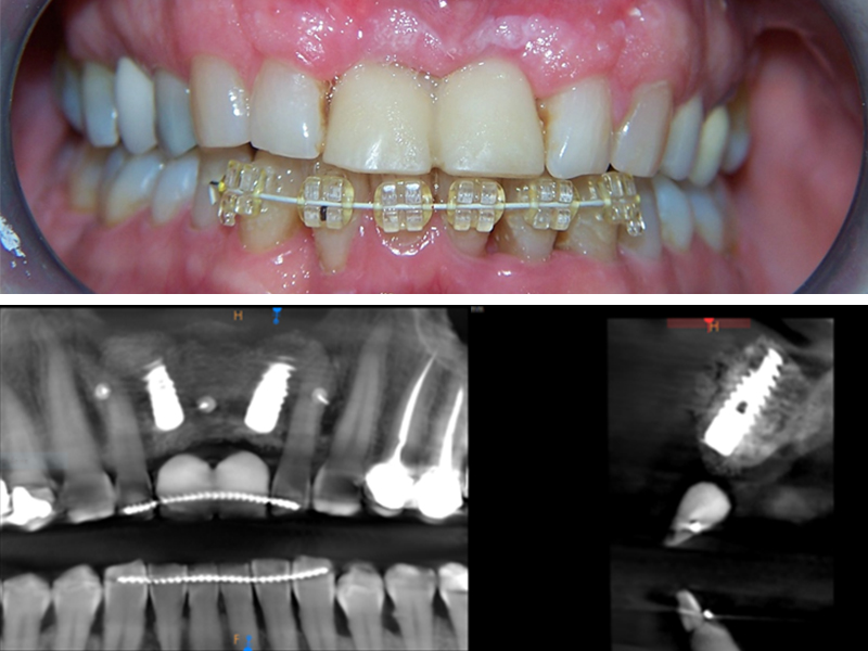 fig-11-article-Jonathan-Amar-extraction