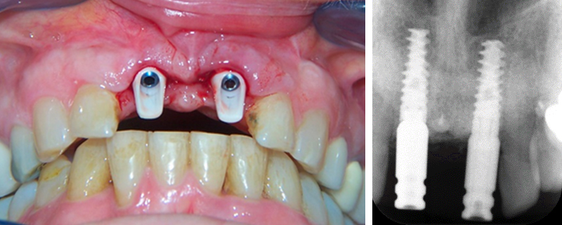 fig-13-article-Jonathan-Amar-extraction