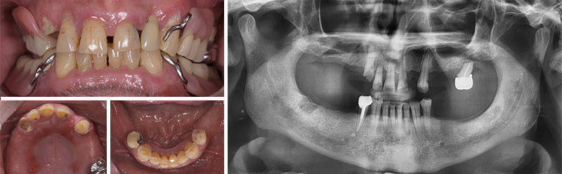Image-1-Cas-clinique-Alexandre-Billon-Prothese-numerique