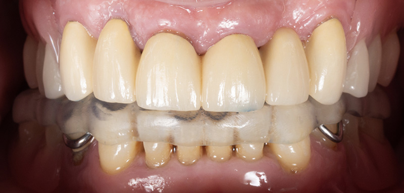 Image-12-Cas-clinique-Alexandre-Billon-Prothese-numerique