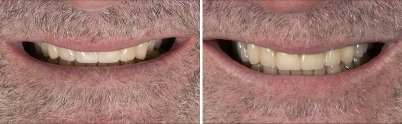 Image-13-Cas-clinique-Alexandre-Billon-Prothese-numerique