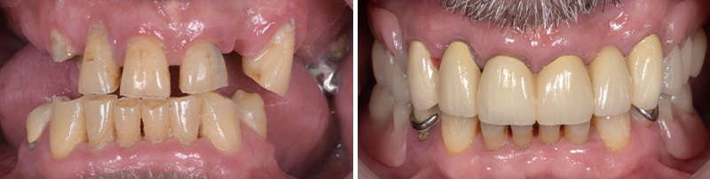 Image-14-Cas-clinique-Alexandre-Billon-Avant-Apres