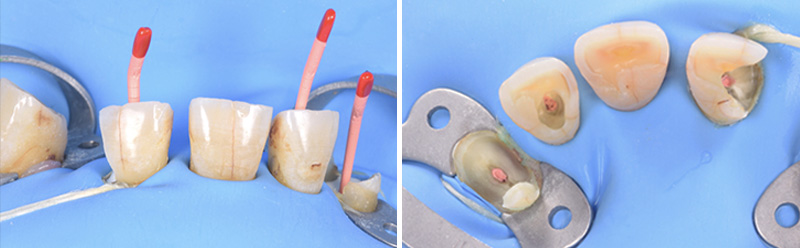 Image-2-Cas-clinique-Alexandre-Billon-Prothese-numerique