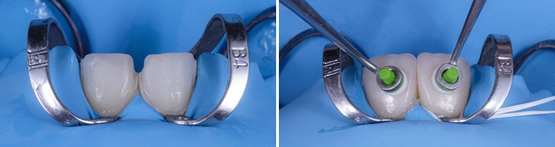 Collage des facettes