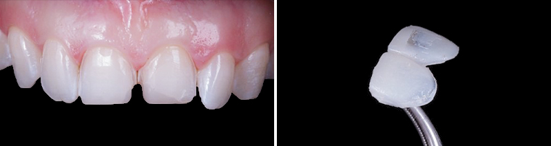 Facettes provisoires