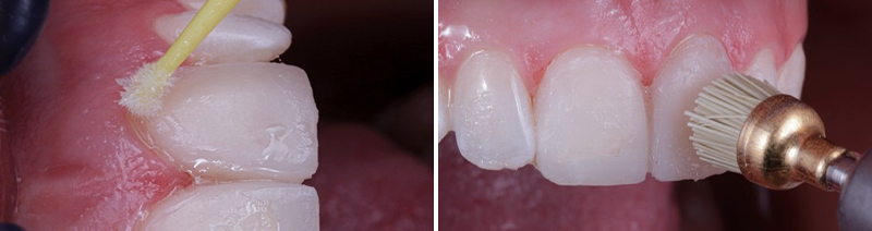 Facettes provisoires