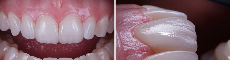 Situation finale à 1 mois post-opératoire