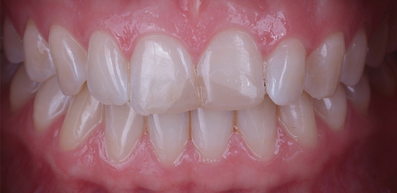 Situation-initiale-Facettes-O-Etienne-Fig-1