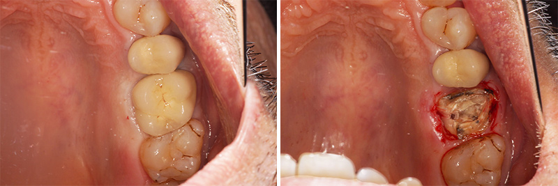 Extraction dent, Ablation de la couronne et de l’inlay core