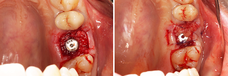 Extraction dent et mise d'une vis de cicatrisation