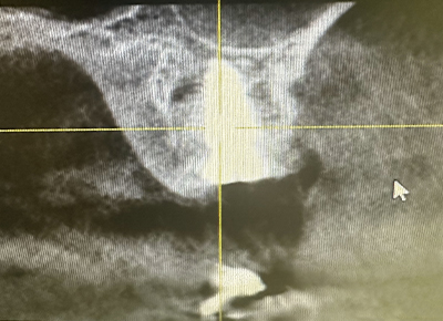 Radio post opératoire