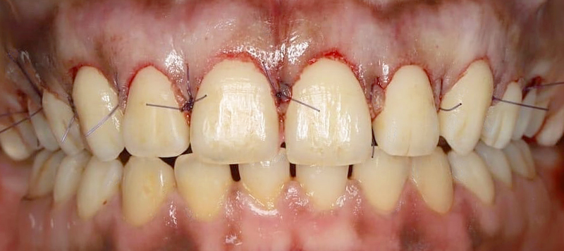 réalisation des gingivectomies à main levée après sondage 