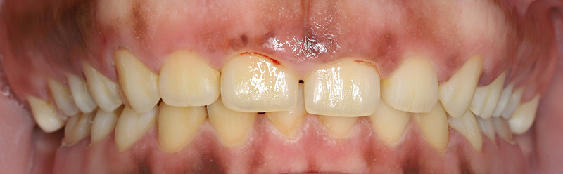 vue intra buccale de la patiente lors de notre première consultation