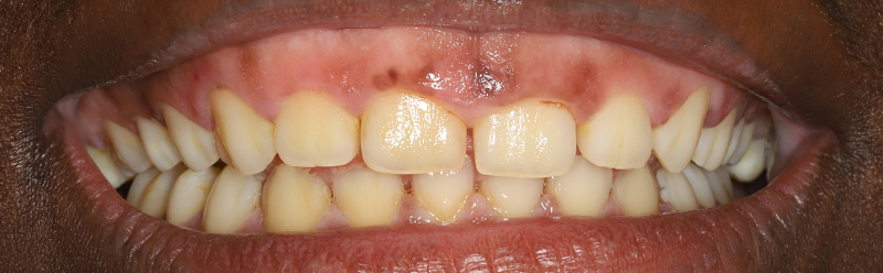 Elongation coronaire, sourire forcé de la patiente qui a du mal à sourire