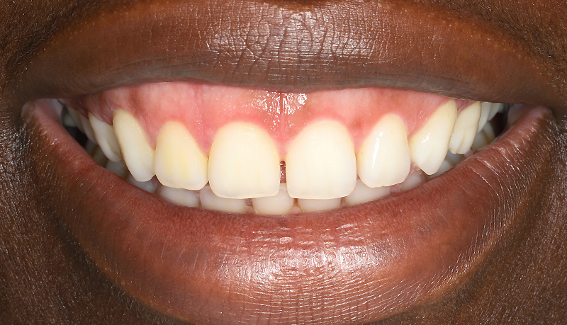 nouveau sourire après 6 semaines d’éclaircissement au peroxyde de carbamide à 10%