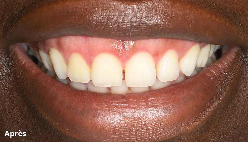 nouveau sourire après élongation coronaire