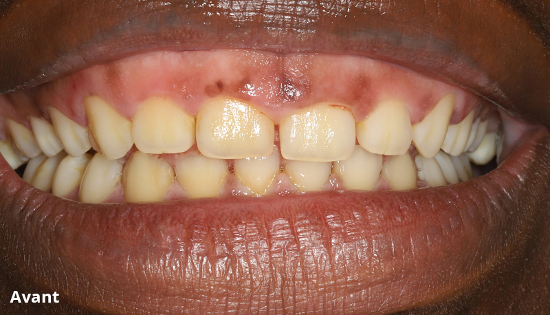 sourire aavant élongation coronaire