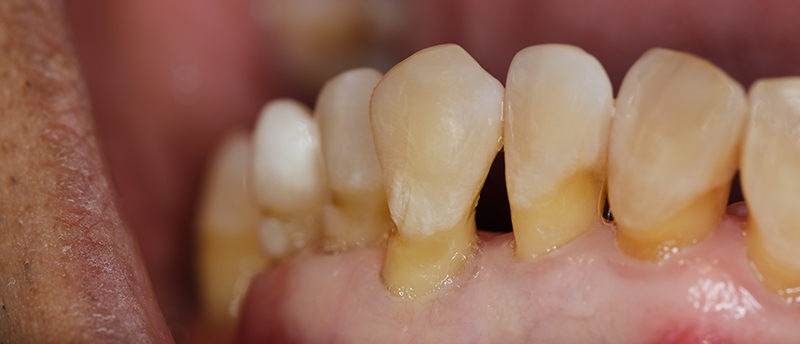 Les racines exposées sont prédisposées au risque carieux