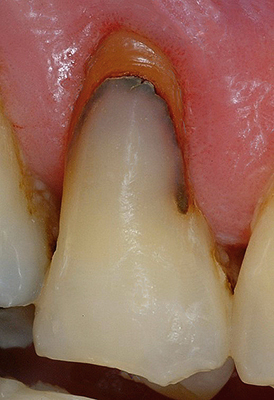 mise en place des résines composites est techniquement plus exigeante
