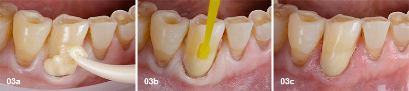 une lésion cervicale est restaurée au moyen d’un verre hybride