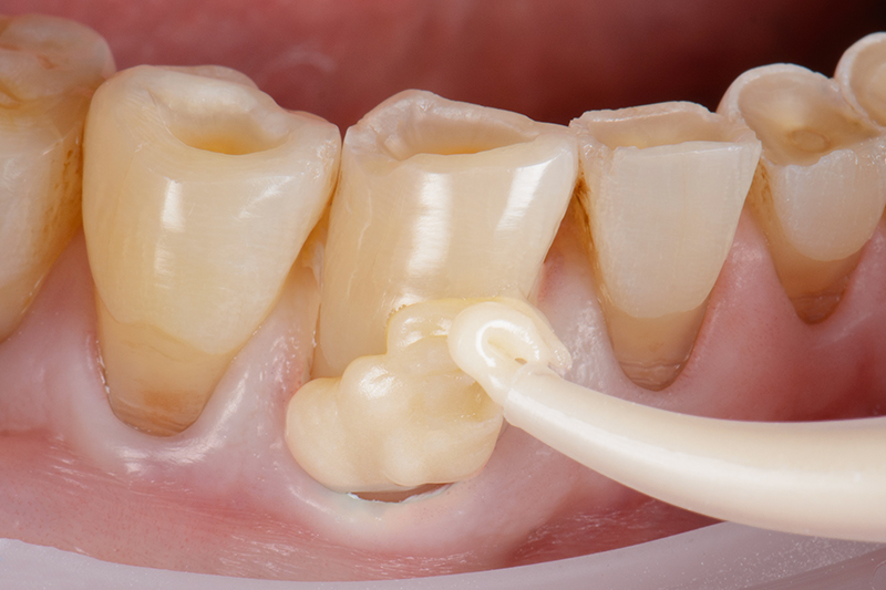 mise en place d’EQUIA Forte HT