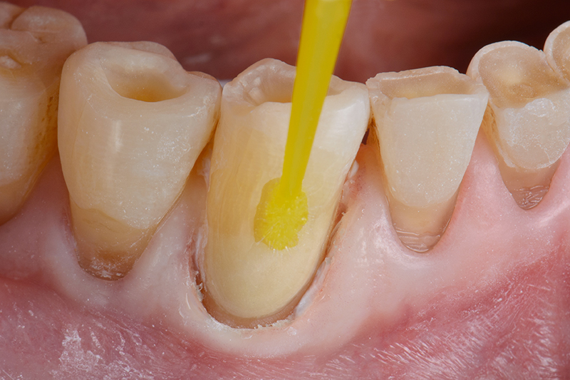 EQUIA Forte Coat crée une surface lisse