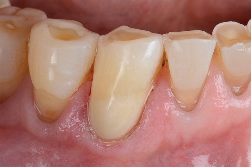 restauration après la finition (avec l’aimable autorisation de J. Tapia Guadix, Espagne)
