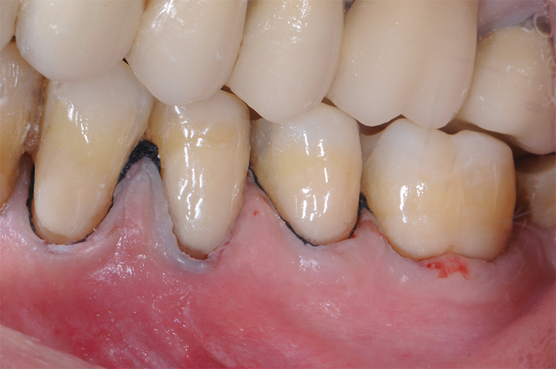restauration initiale par un verre hybride