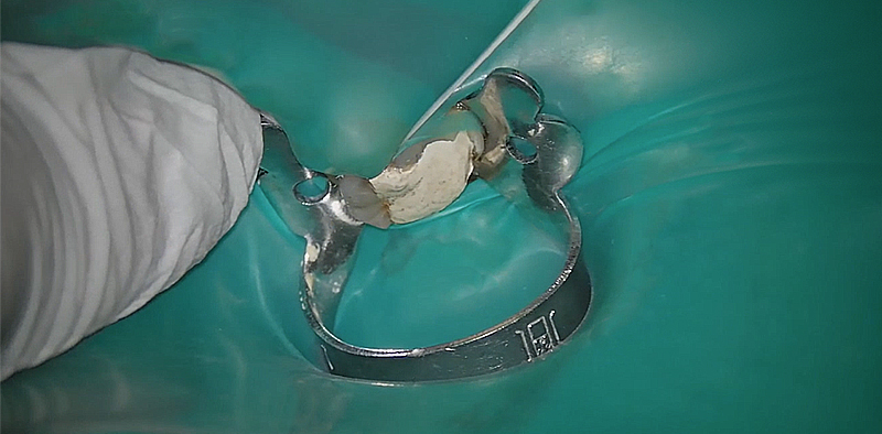 Pose d'une digue avec la technique des ailettes