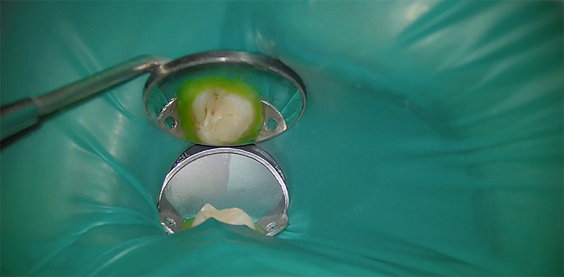 Pose d'une digue avec la technique directe 