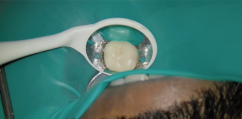 Pose d'une digue avec la technique parachute