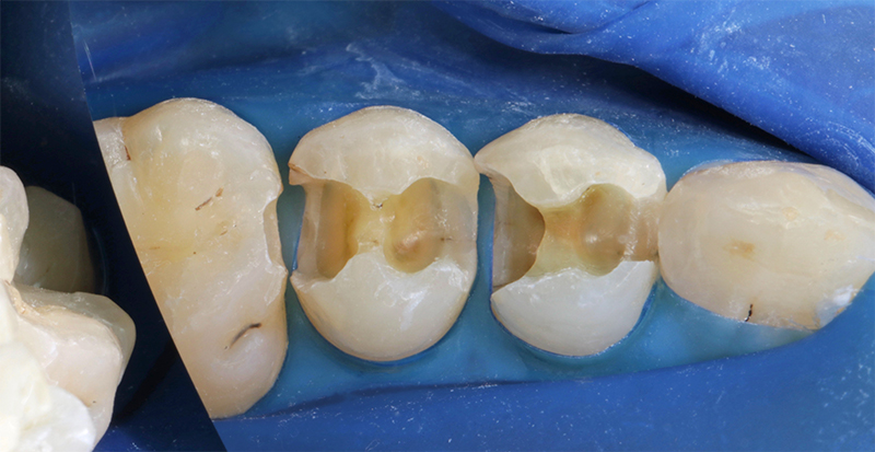 Protocole : dépose des amalgames et retrait des lésions carieuses sur 14 et 15