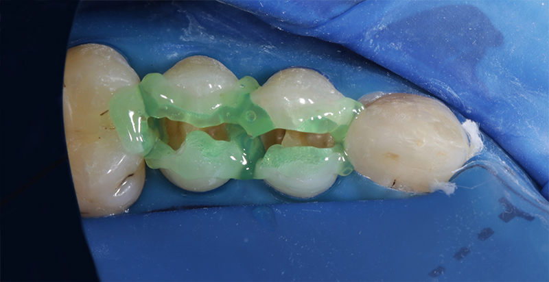 Protocole : mordançage sélectif de l'émail avec de l'acide phosphorique à 37 % pendant 30 secondes