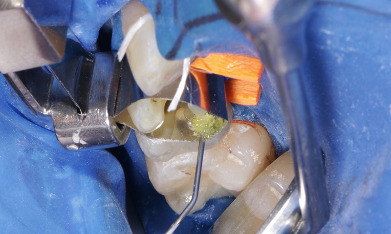 Collage avec Adhese Universal et polymérisation en 3 secondes