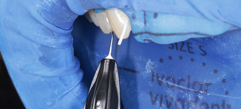 Collage avec Adhese Universal