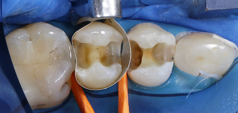 Matrice conventionnelle Tofflemire