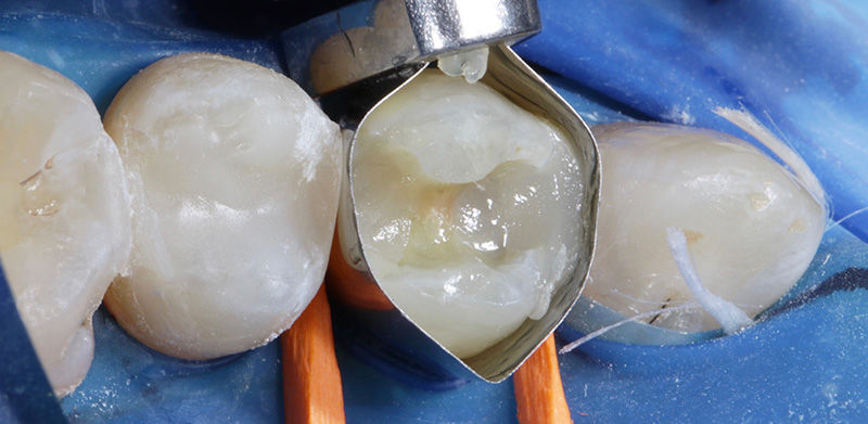 Vue occlusale après obturation avec Tetric PowerFlow