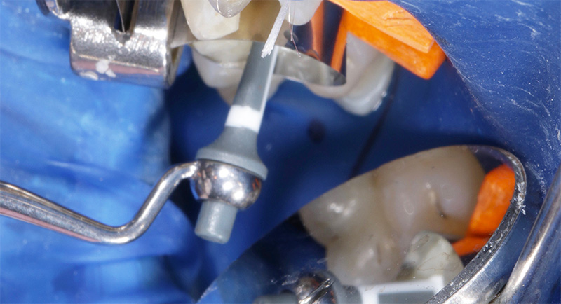 Stratification du matériau Tetric PowerFill à l'aide d'OptraSculpt