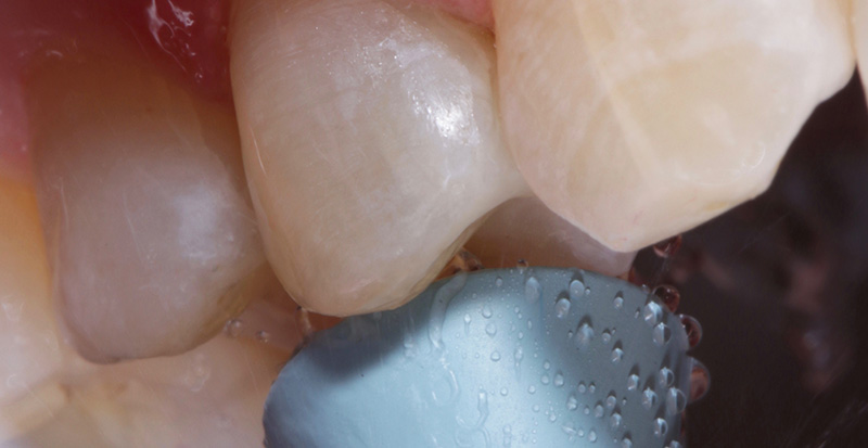 Polissage avec une pointe à polir OptraGloss