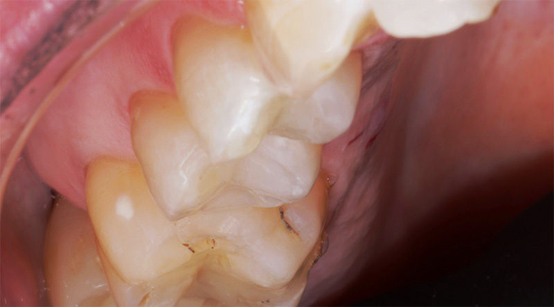 Restaurations terminées sur les dents 14 à 16