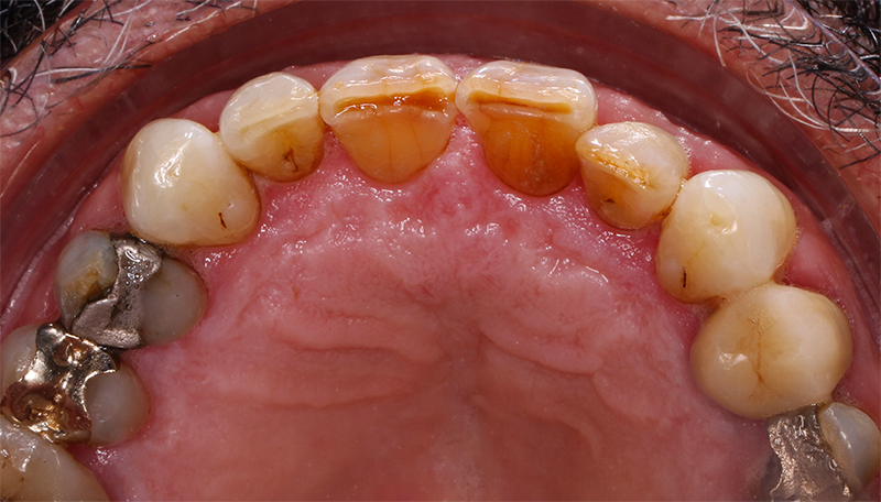 Vue éclaircissement ambulatoire fin traitement