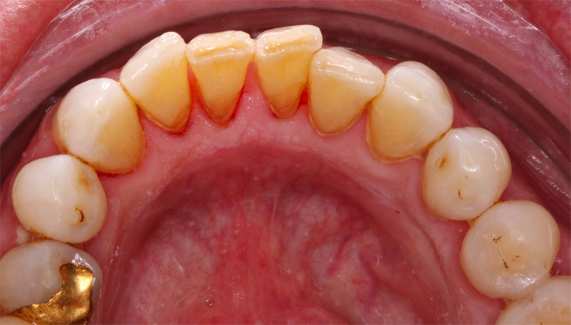Vue éclaircissement ambulatoire fin traitement