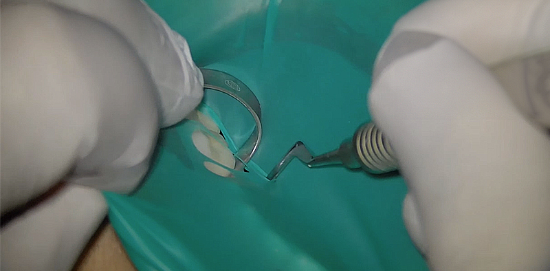 Pose d'une digue avec la technique de la digue fendue