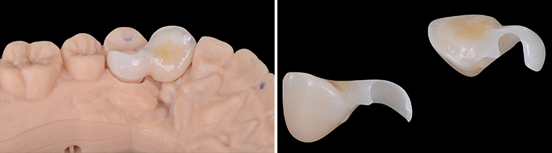 bridge cantilever zircone, 2ème séance