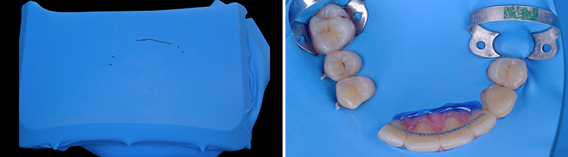 bridge cantilever zircone, 3ème séance