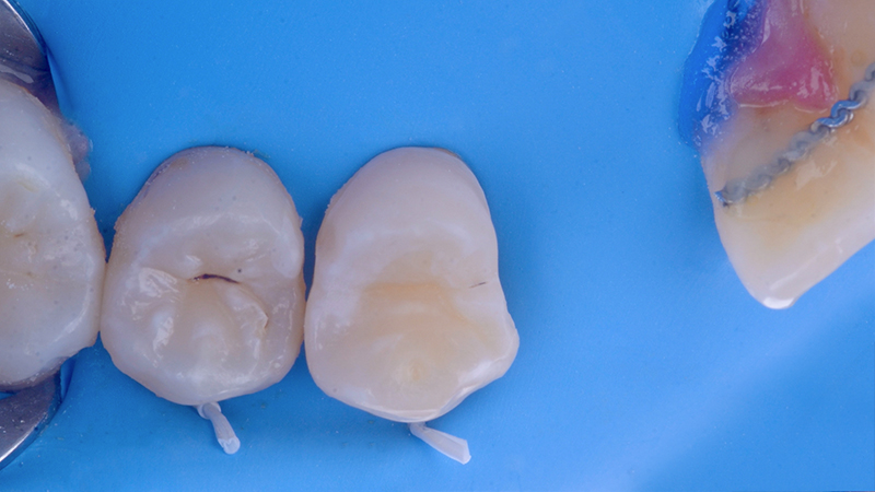 bridge cantilever zircone, 3ème séance