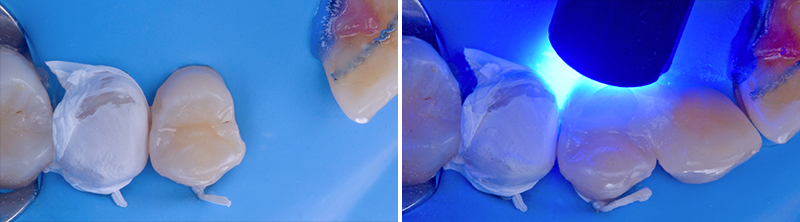 isolation de la 15 à l’aide d’une bande de Téflon et élimination des excès de colle