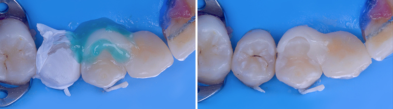 joint collé recouvert d’une couche de glycérine puis photopolymérisé