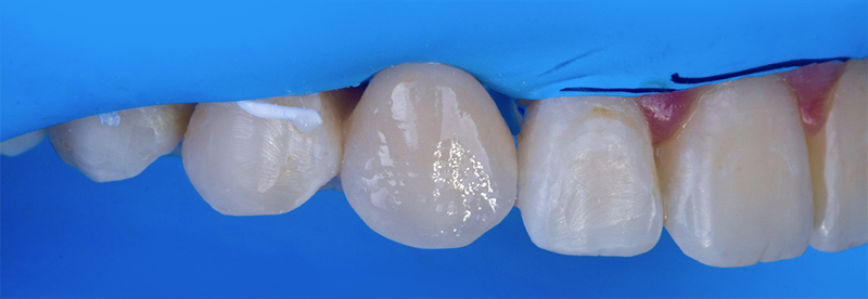 photopolymérisé à nouveau pour améliorer son vieillissement en éliminant la couche de surface inhibée par l’oxygène