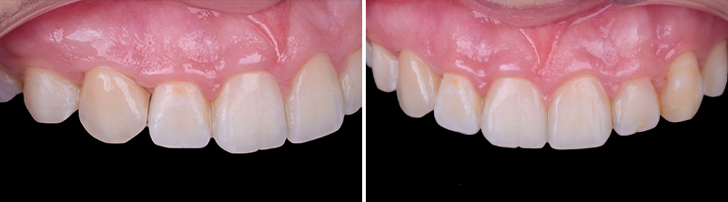 bridge cantilever zircone, vues finales